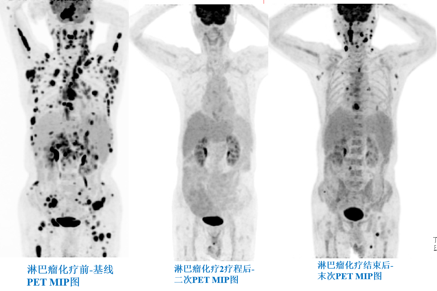 淋巴瘤化療前、中、后PETCT療效評價.png