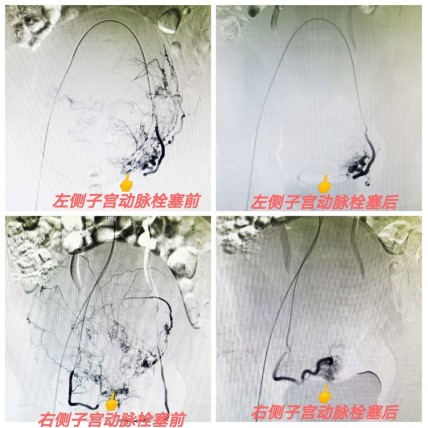 子宮肌瘤.jpg