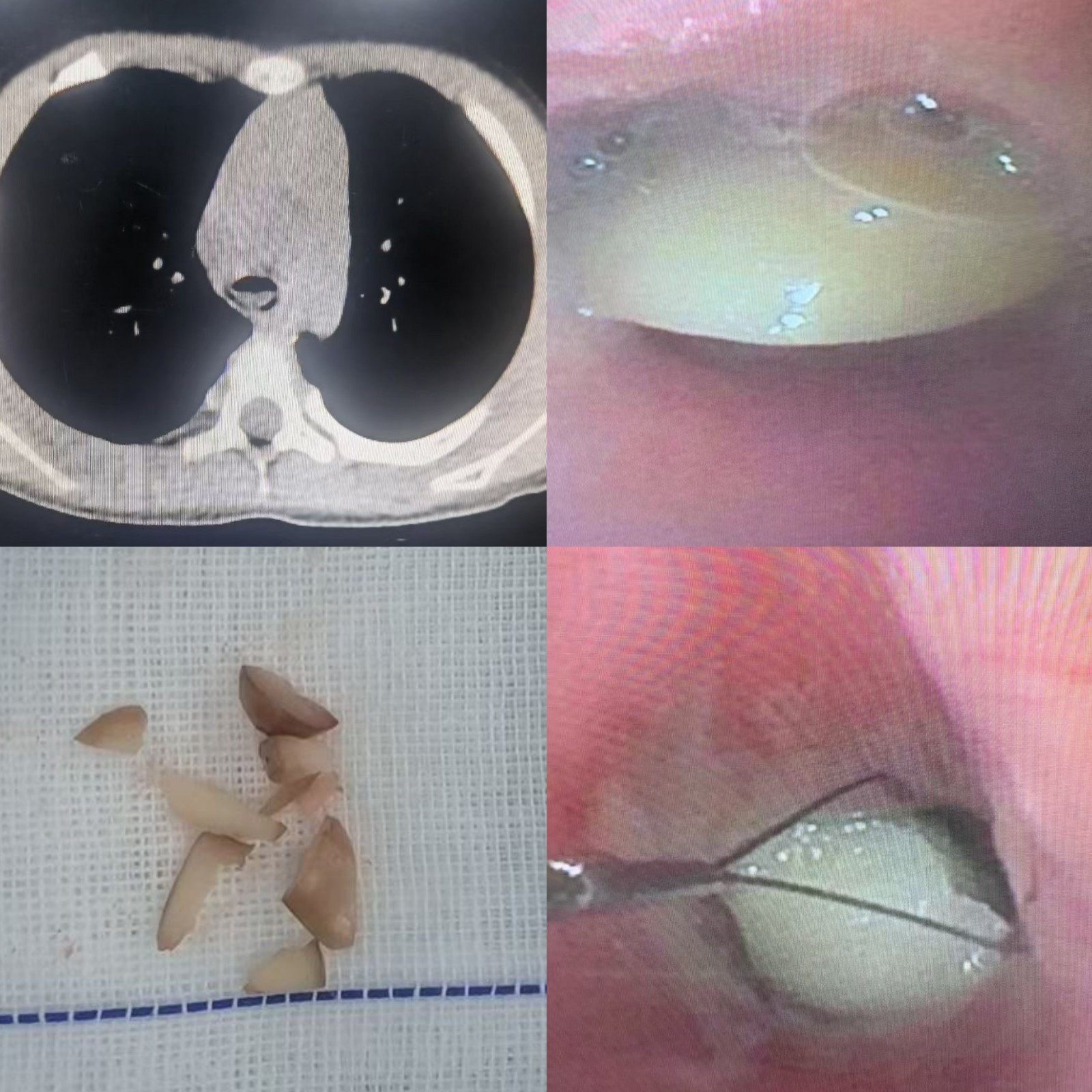 氣管內異物-花生.jpg
