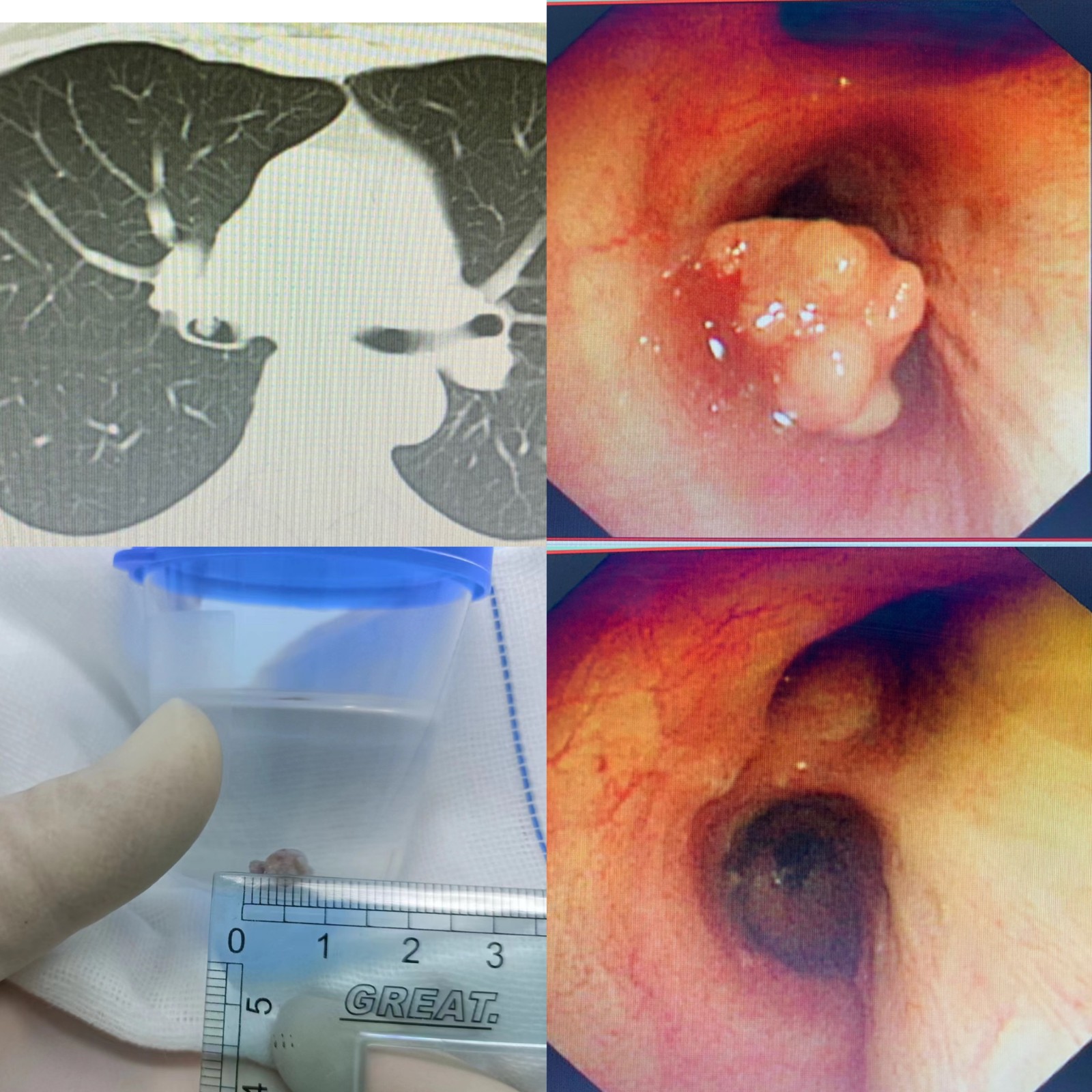 氣管內腫物切除.jpg