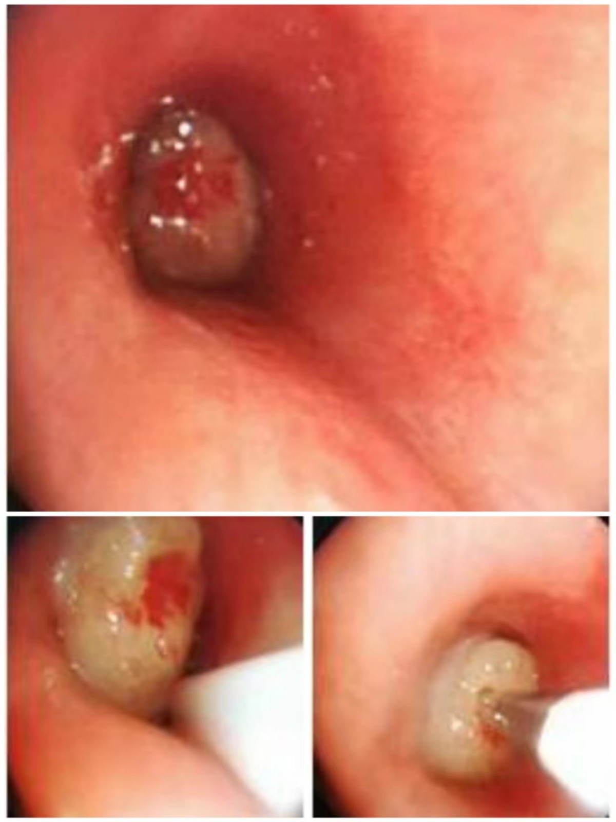 腫瘤切除+CO2冷凍術.jpg